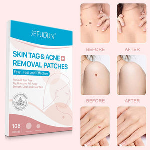 Acne Skin Tag Remover – Wart &amp; Blackhead Removal Patch for Flawless Skin